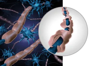 multiple sclerosis - healthy and exposed nerve fibres