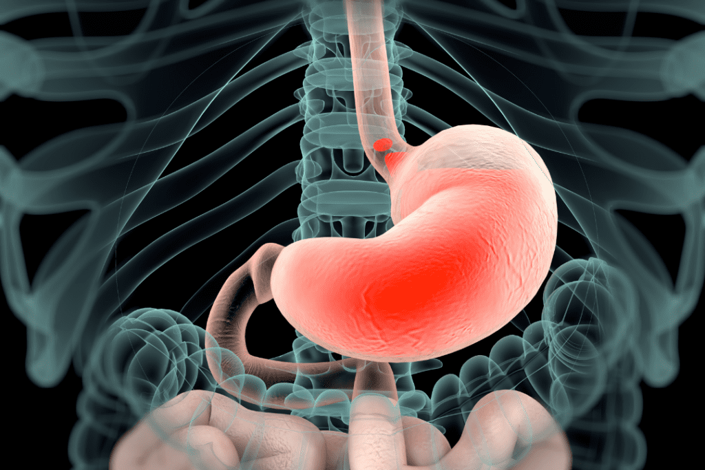 Acid reflux image