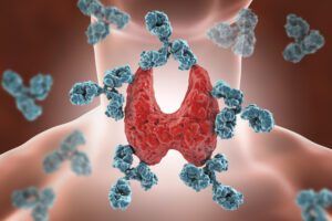 Autoimmune Thyroiditis Hashimoto's Disease. 3d Illustration Showing Antibodies Attacking Thyroid